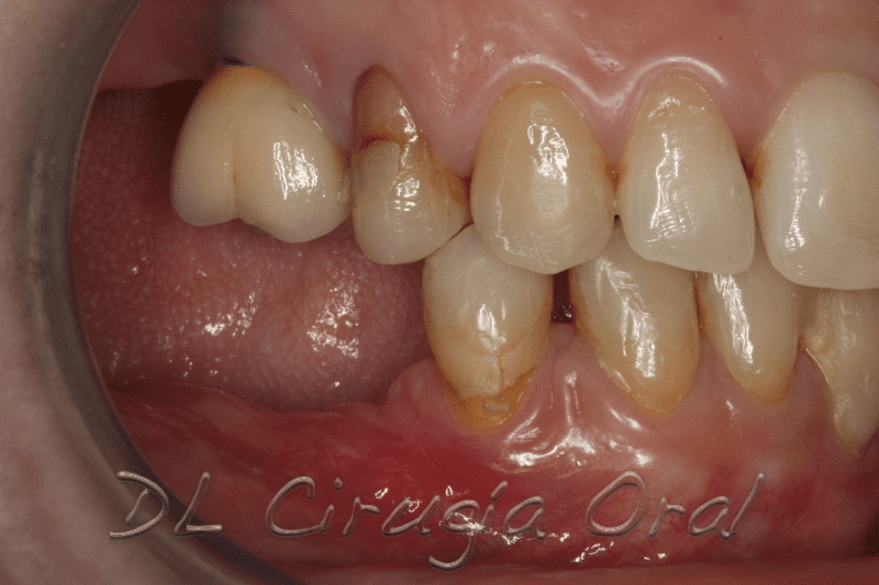 atrophic posterior mandible reconstruction