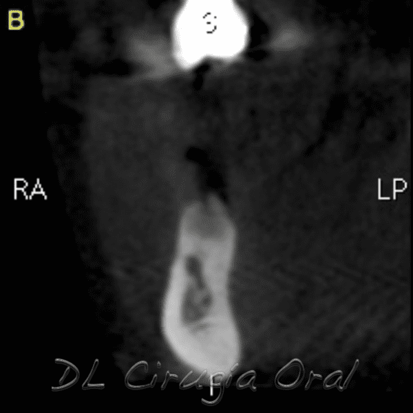 atrophic posterior mandible reconstruction