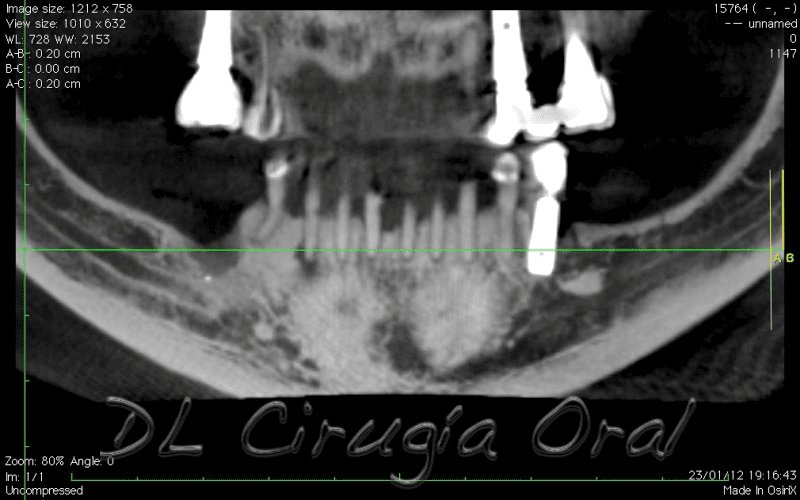 atrophic posterior mandible reconstruction