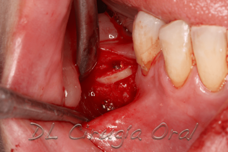 atrophic posterior mandible reconstruction