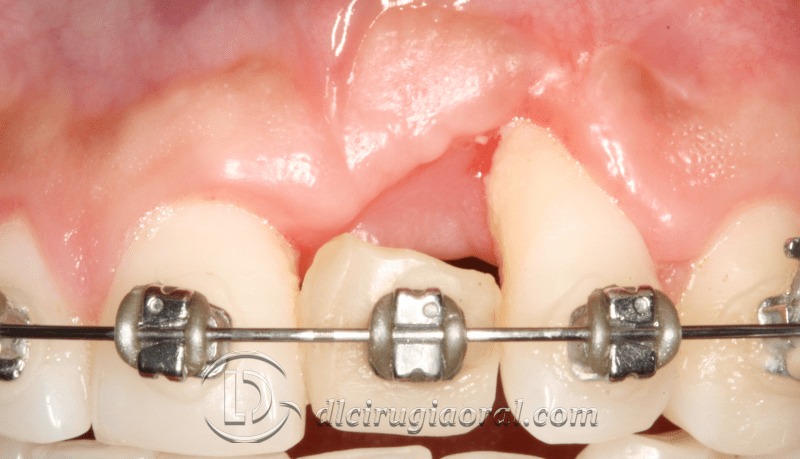 Reconstruction After Failed Implant and Graft