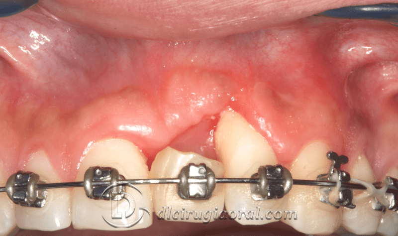 reconstruction after failed implant