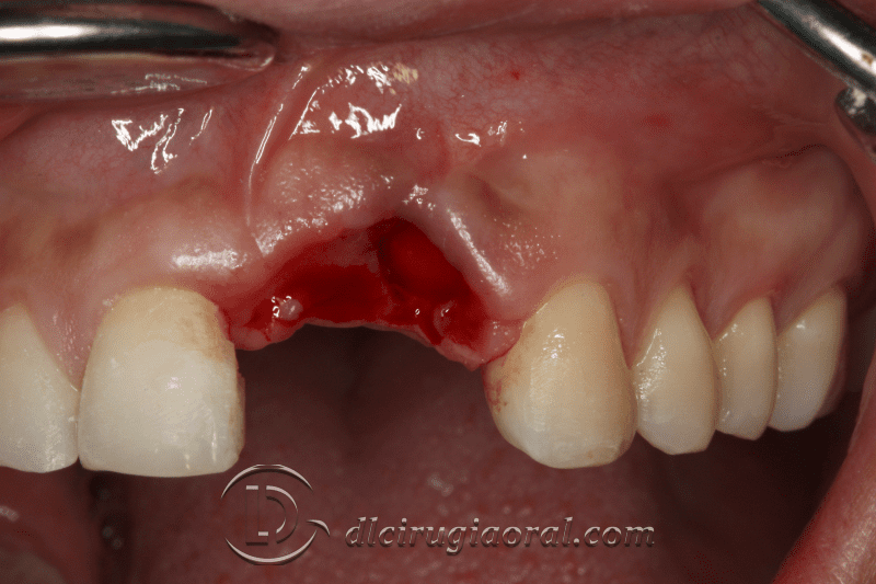 reconstruction after failed implant