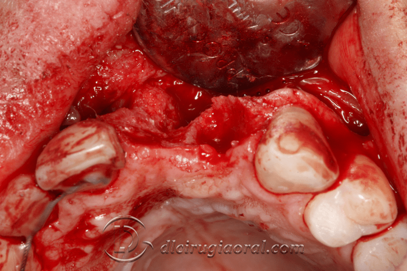 reconstruction after failed implant