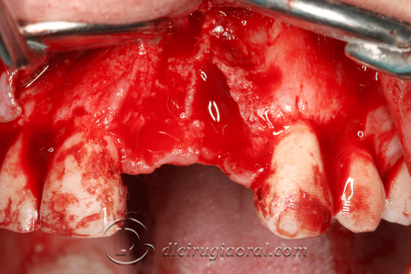 reconstruction after failed implant
