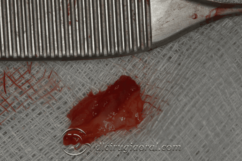 reconstruction after failed implant