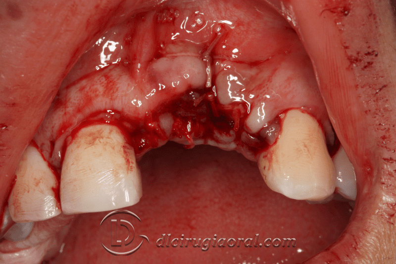 reconstruction after failed implant