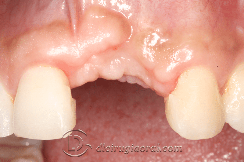 reconstruction after failed implant