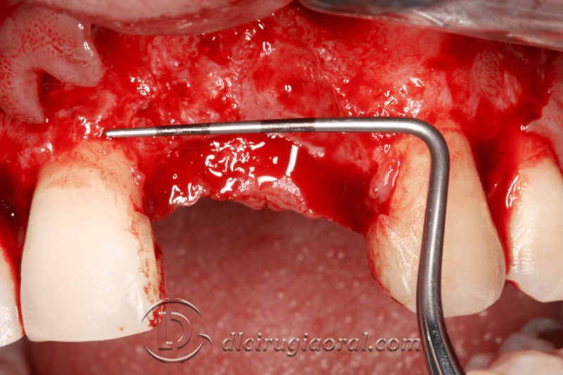 reconstruction after failed implant