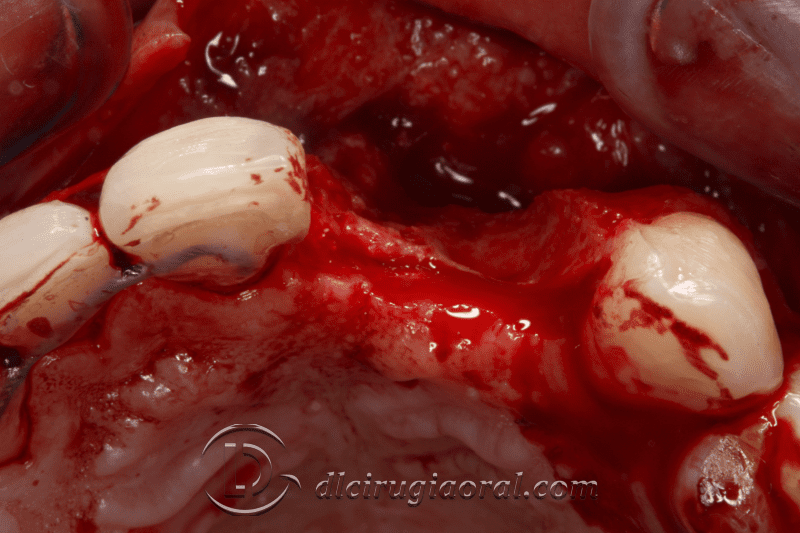 reconstruction after failed implant
