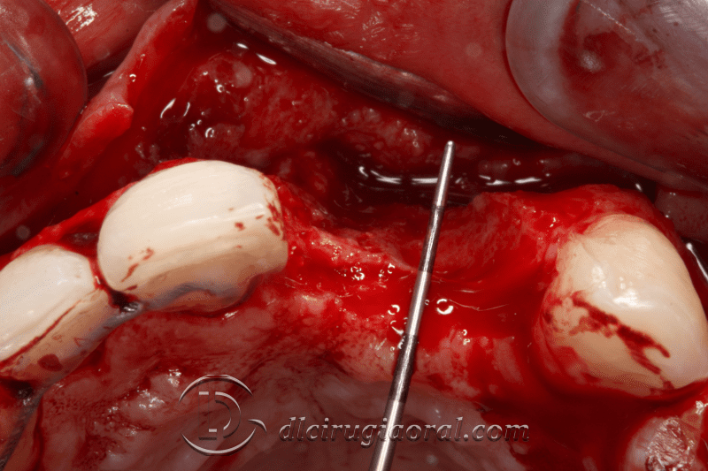 reconstruction after failed implant