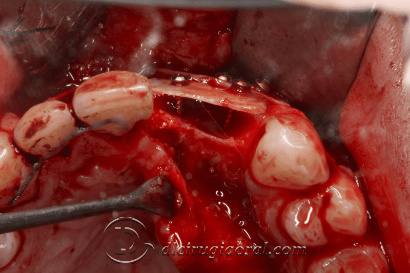 reconstruction after failed implant