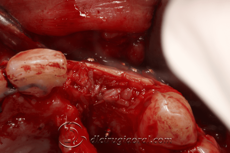 reconstruction after failed implant