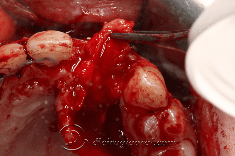 reconstruction after failed implant