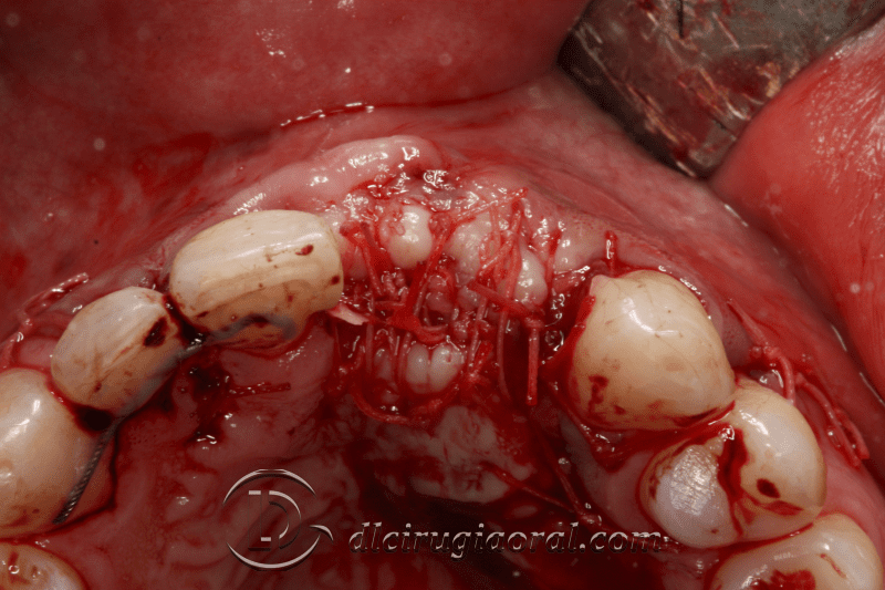 reconstruction after failed implant