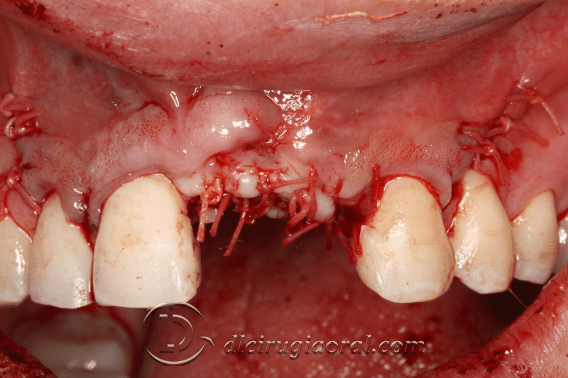 reconstruction after failed implant