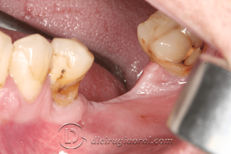 Kazanjian vestibuloplasty