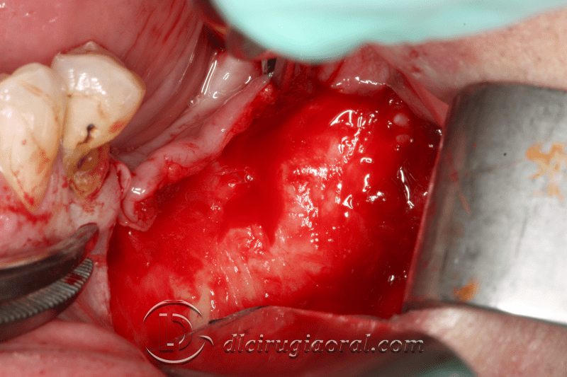Kazanjian vestibuloplasty