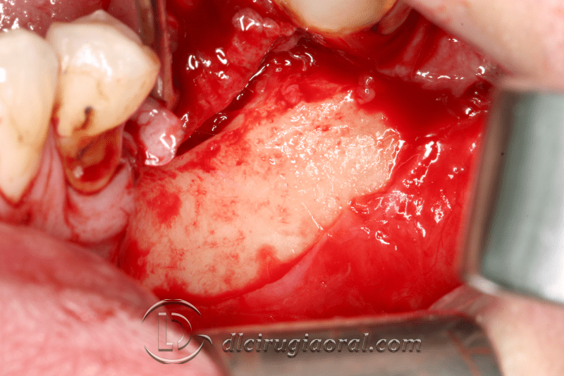 Kazanjian vestibuloplasty
