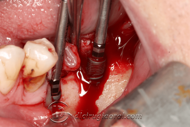 Kazanjian vestibuloplasty