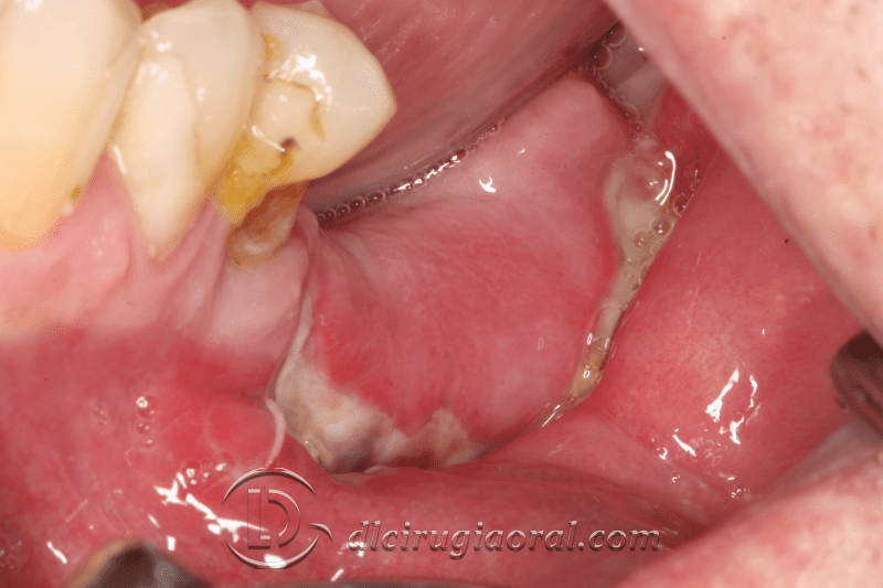 Kazanjian vestibuloplasty