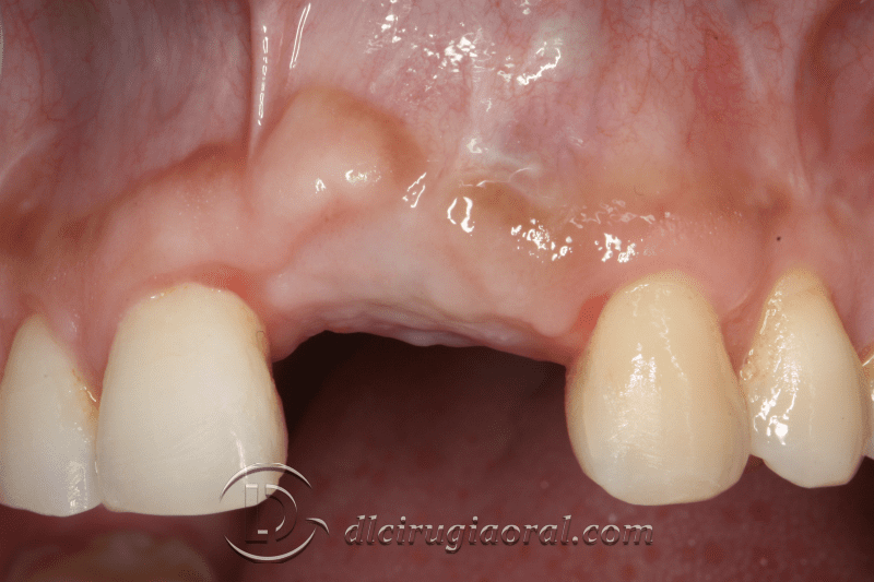 reconstruction after failed implant