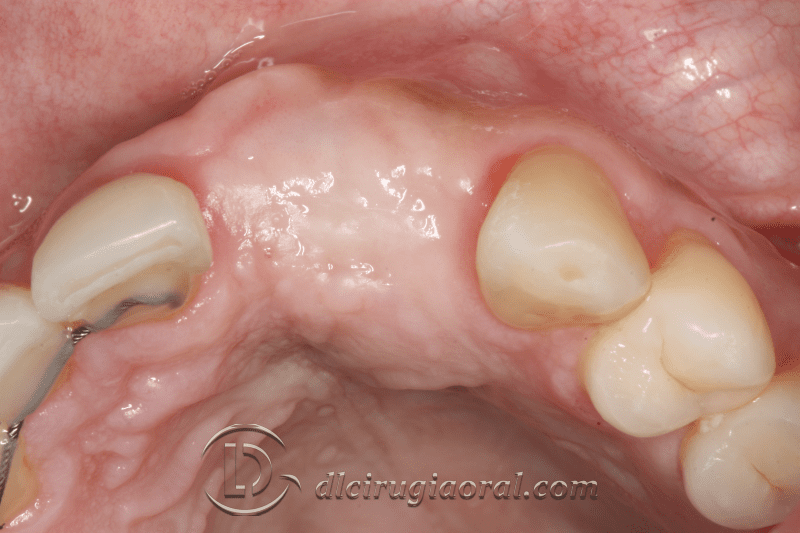 reconstruction after failed implant