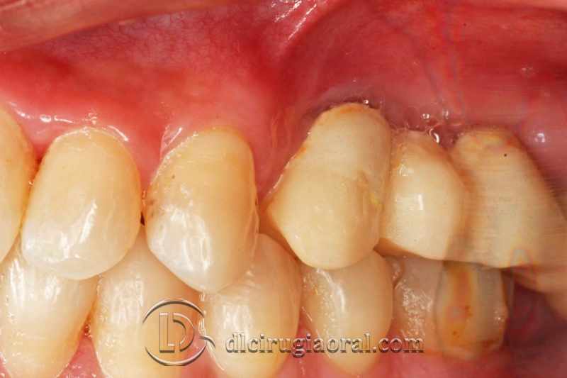 explantation and implantation with sinus lift