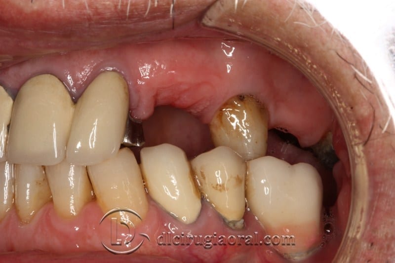 block regeneration and sinus lift