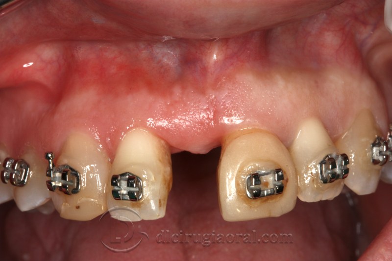 atrophy in central incisor