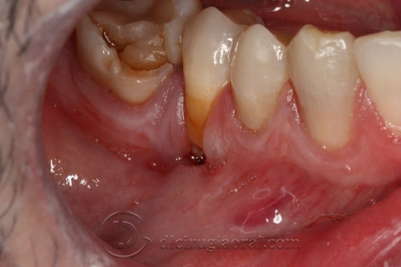 mandibular reconstruction
