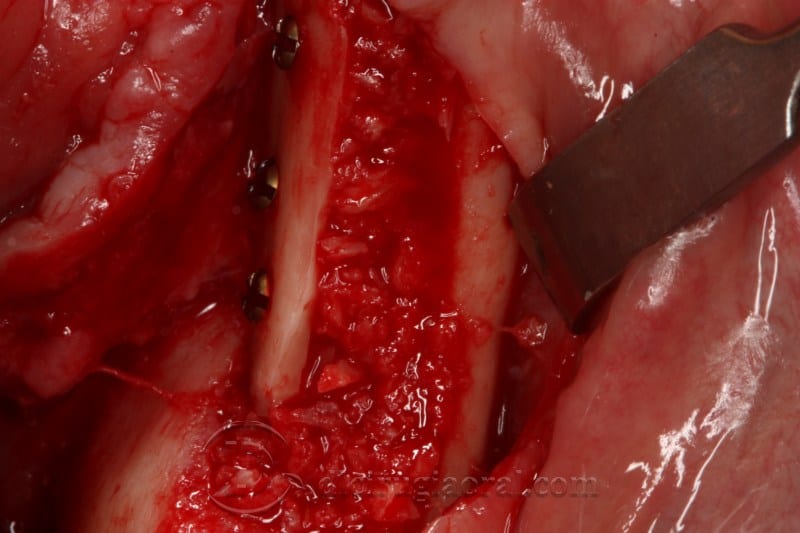 mandibular reconstruction