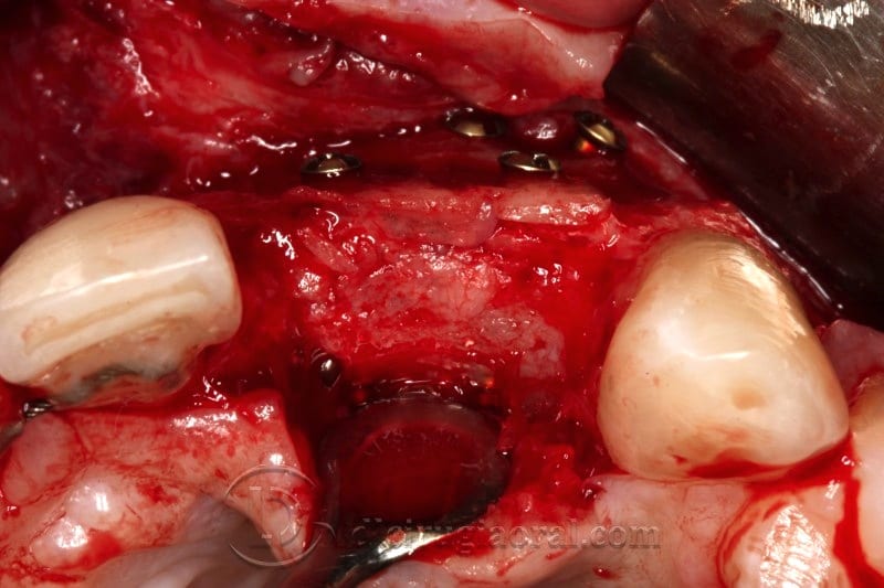 Screws completely covered by bone