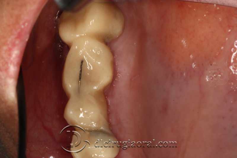 explantation and implantation with sinus lift