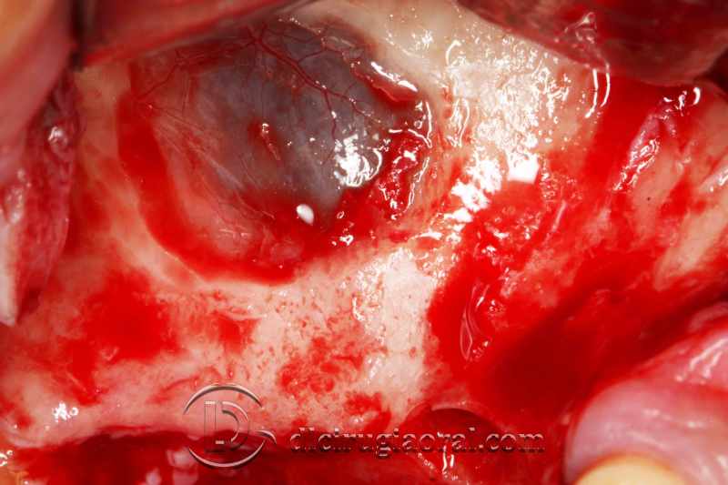explantation and implantation with sinus lift