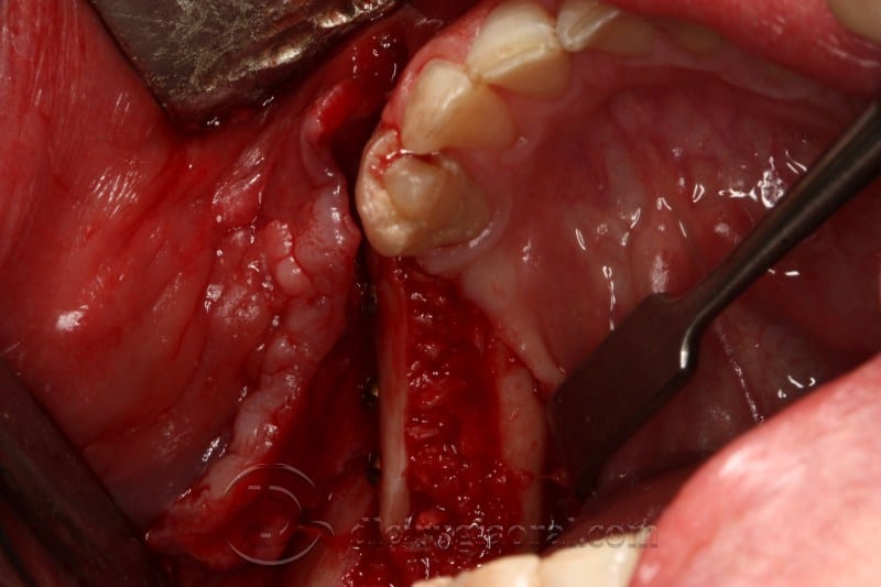 mandibular reconstruction
