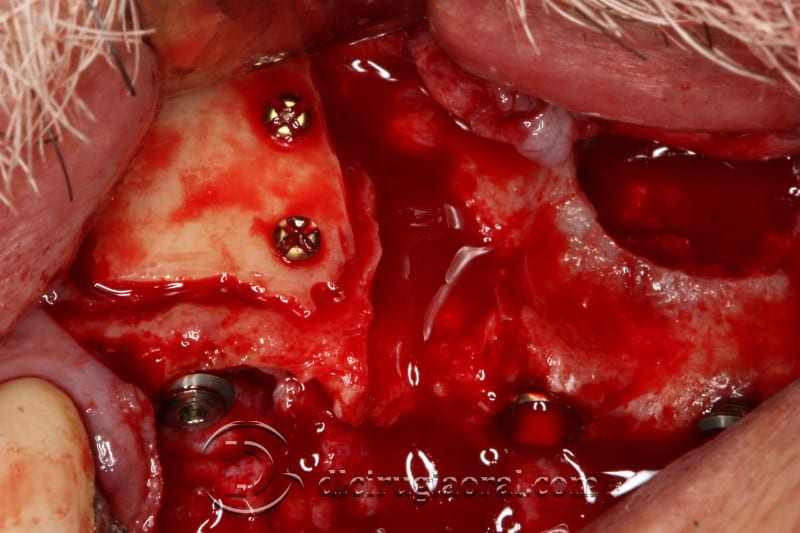 block regeneration and sinus lift