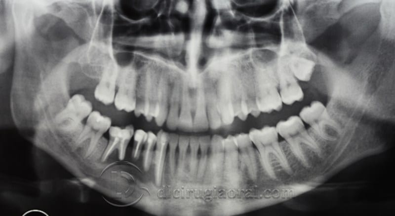 mandibular reconstruction