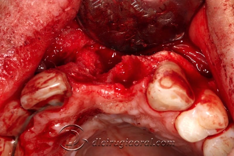 Defect occlusal view