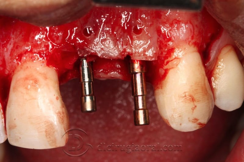 Implant parallelism
