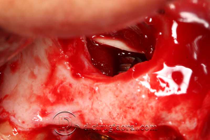 explantation and implantation with sinus lift