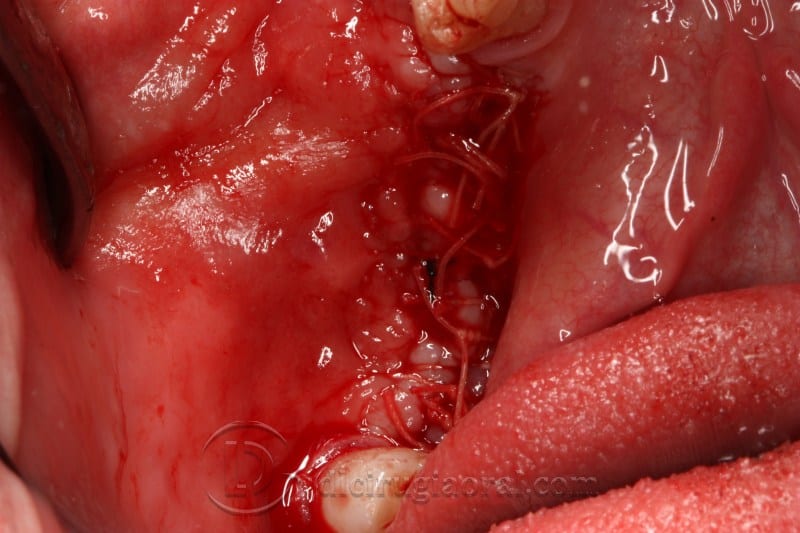 mandibular reconstruction