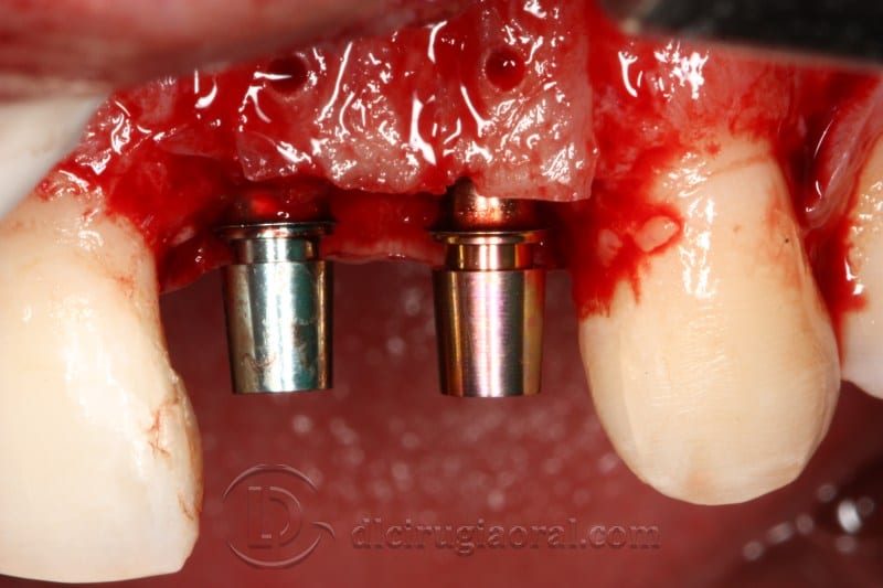 Implants placed