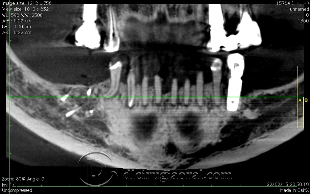 implant surgery in the mandible