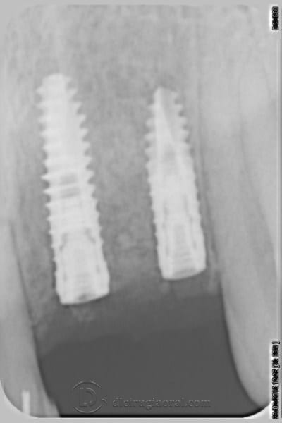 Intraoperative plate