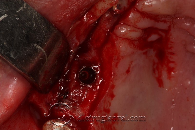 block regeneration and sinus lift
