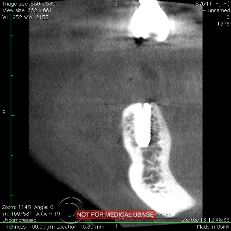 implant surgery in the mandible