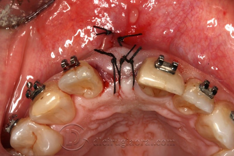 atrophy in central incisor