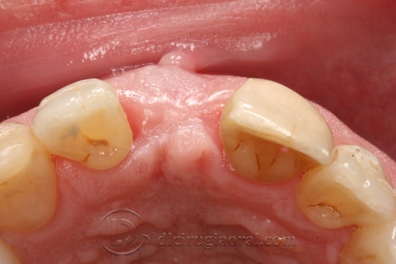 atrophy in central incisor
