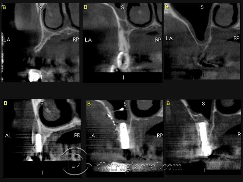 block regeneration and sinus lift